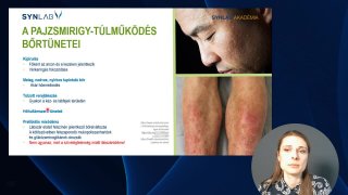 A pajzsmirigy túlműködés tünetei