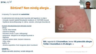 13 - Élelmiszer - adalékanyag allergia