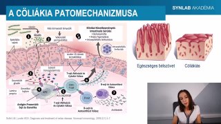 2 - Cöliákia patomechanizmusa